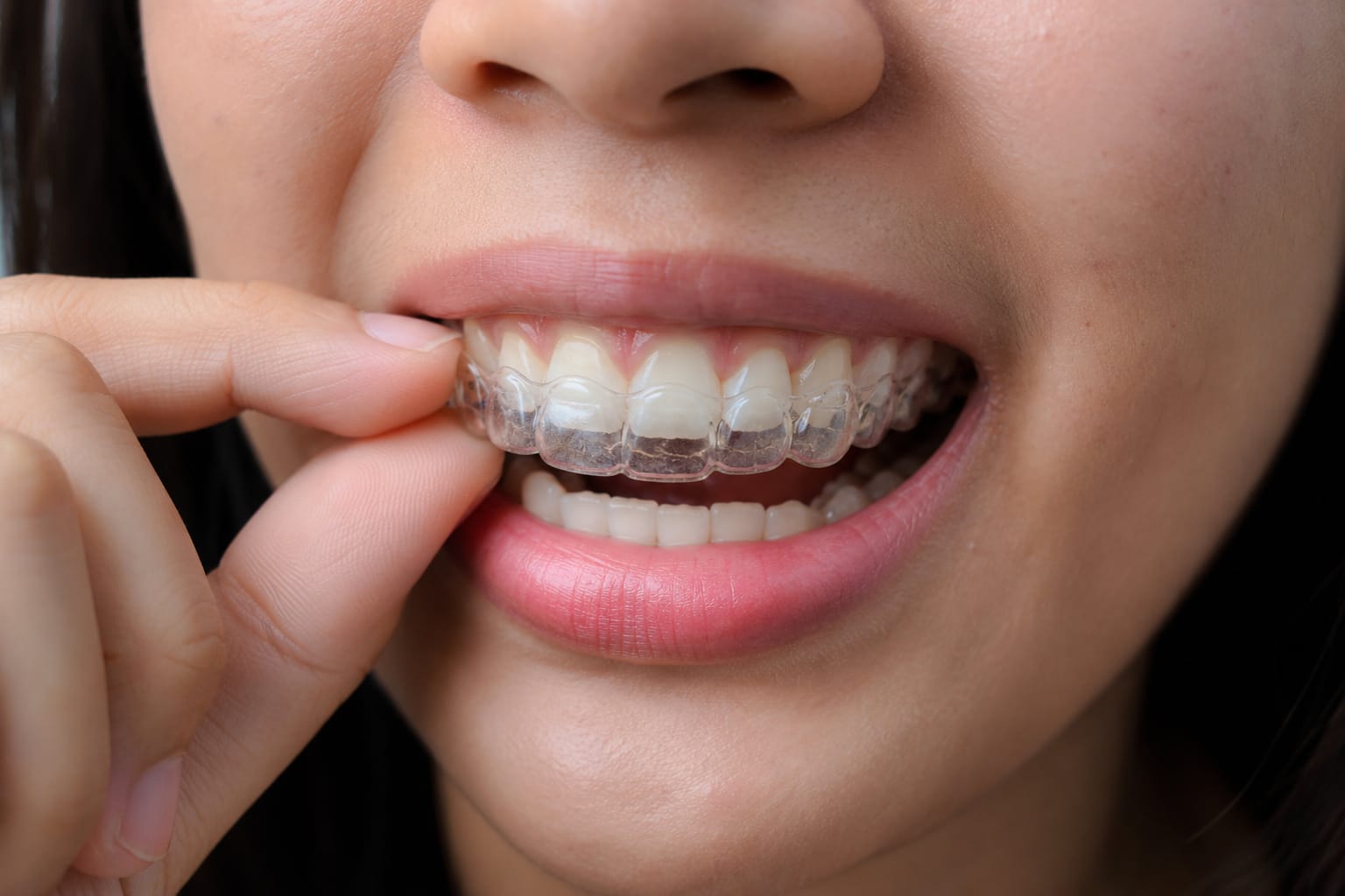 Clear Aligners & Orthodontics at Mukhil General and Dental Clinic, Madurai