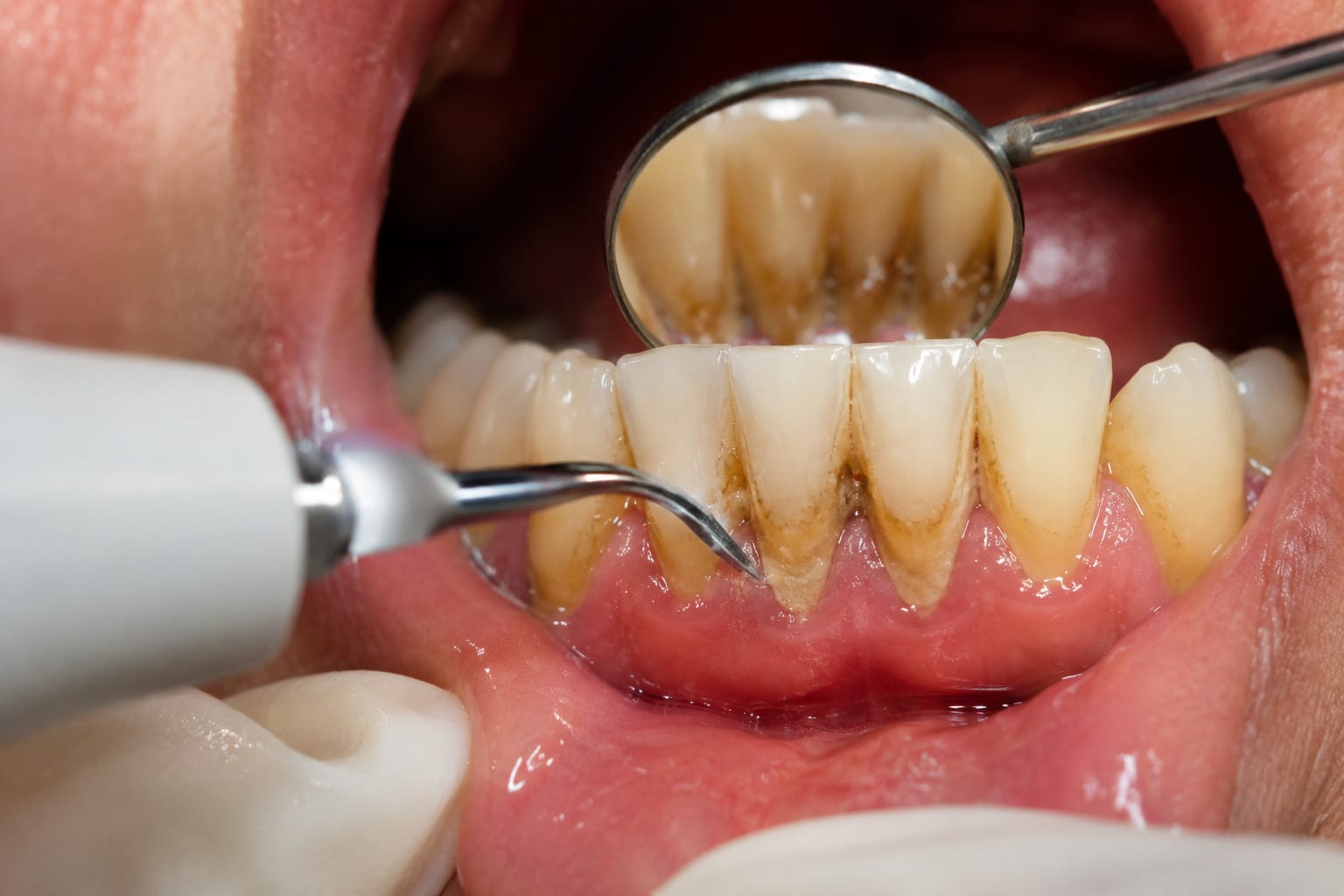 Teeth Cleaning at Mukhil General and Dental Clinic, Madurai