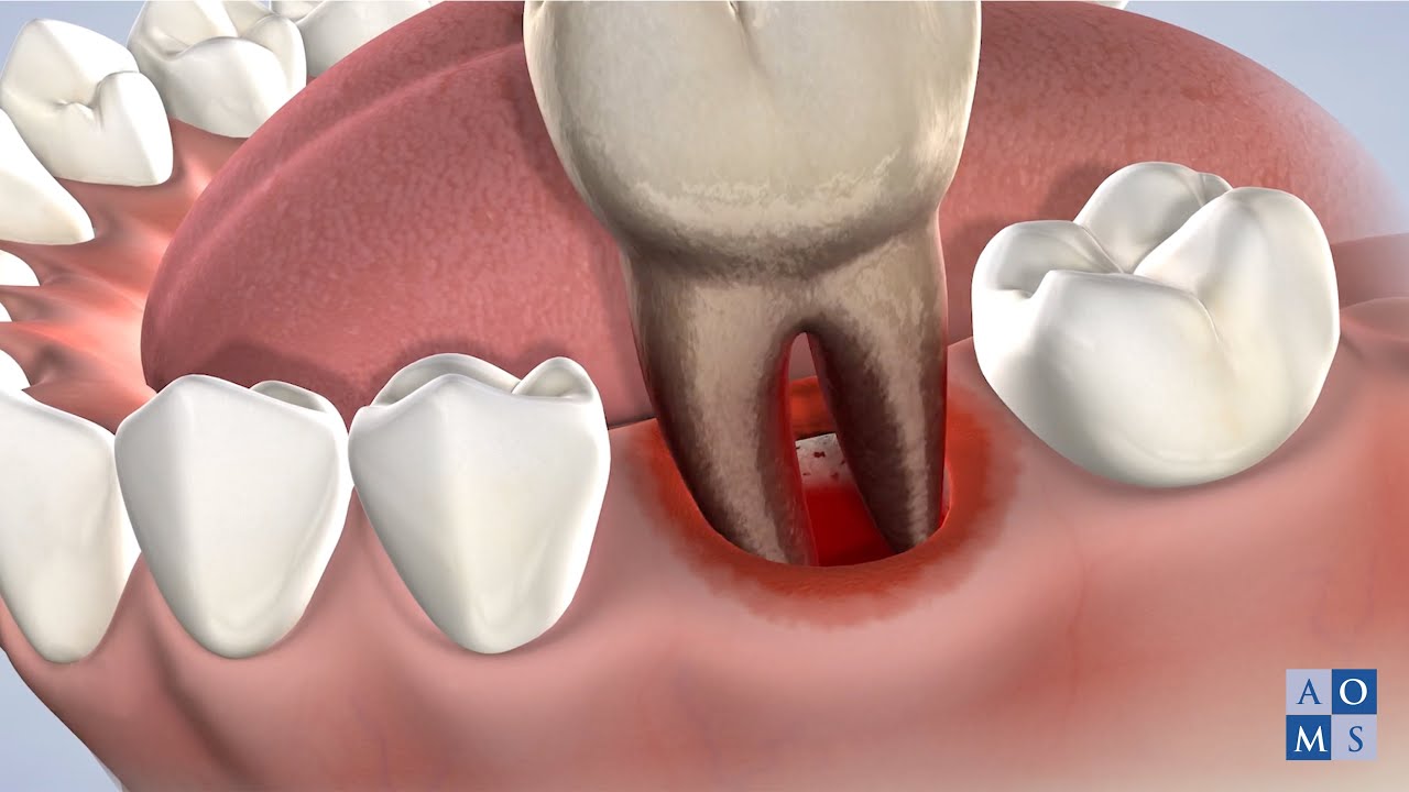 Tooth Extraction at Mukhil General and Dental Clinic, Madurai
