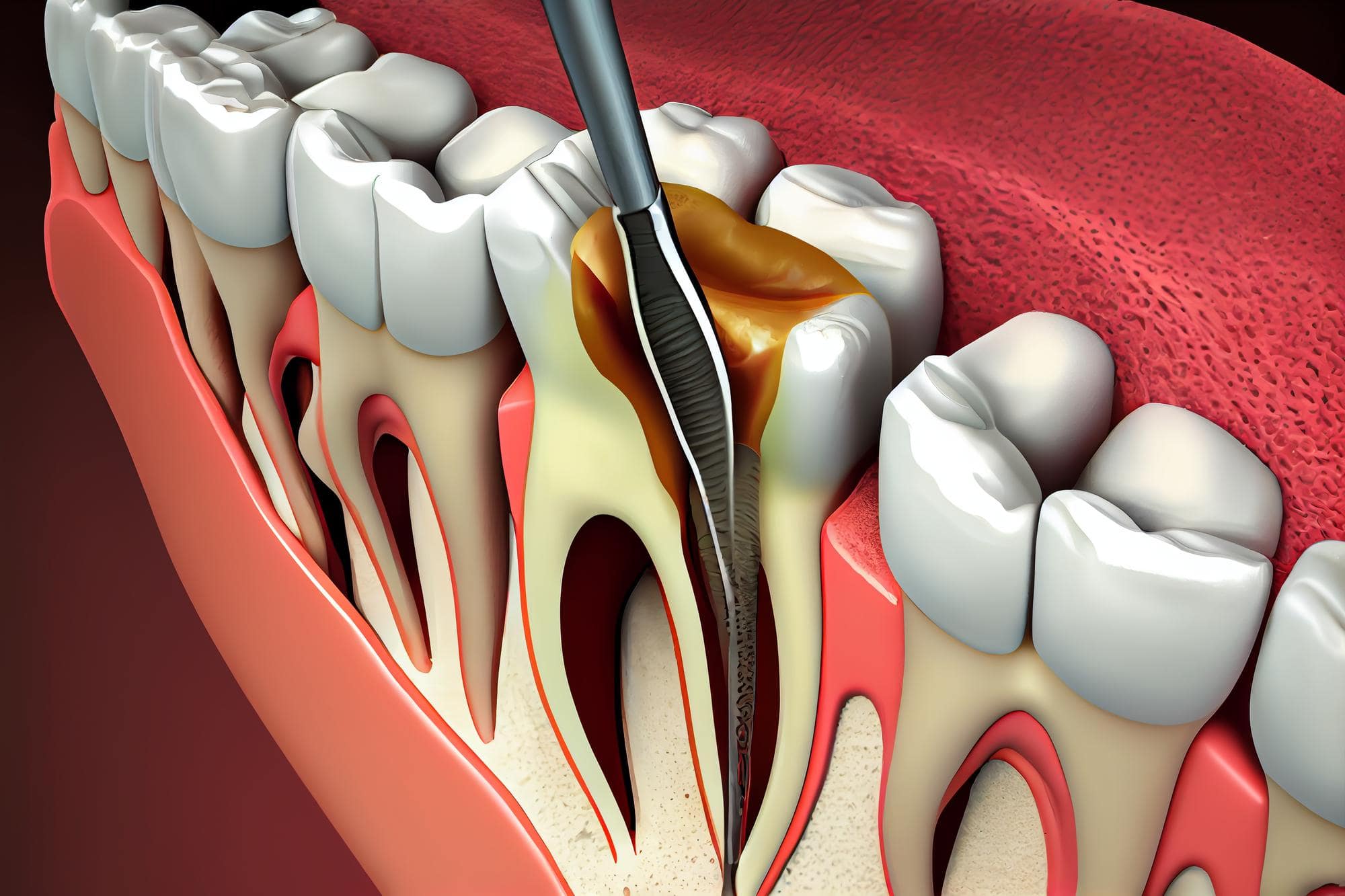 Root Canal Treatment at Mukhil General and Dental Clinic, Madurai